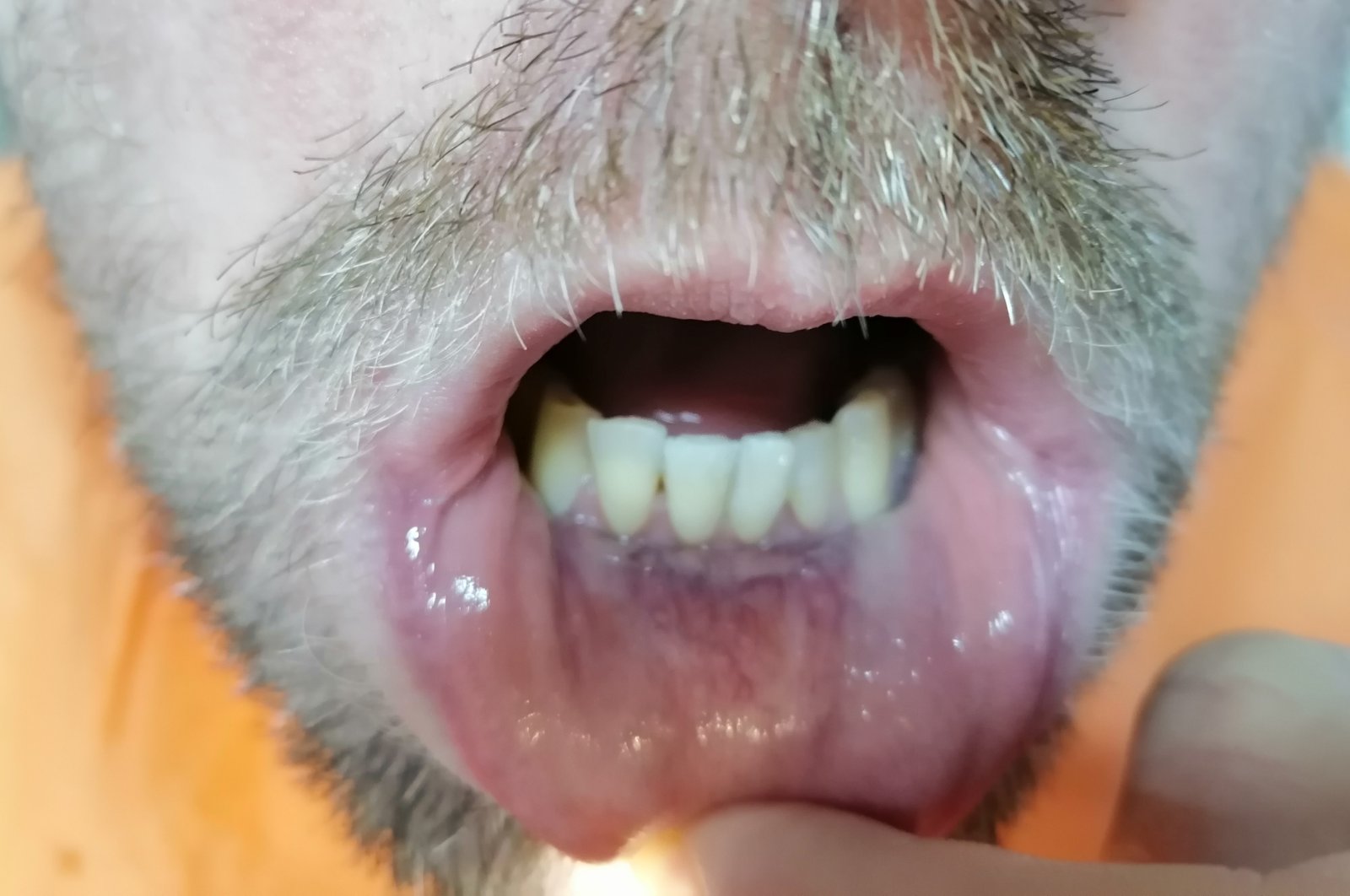 Pre